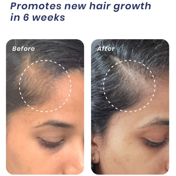 Nuvio Hair Growth Treatment
